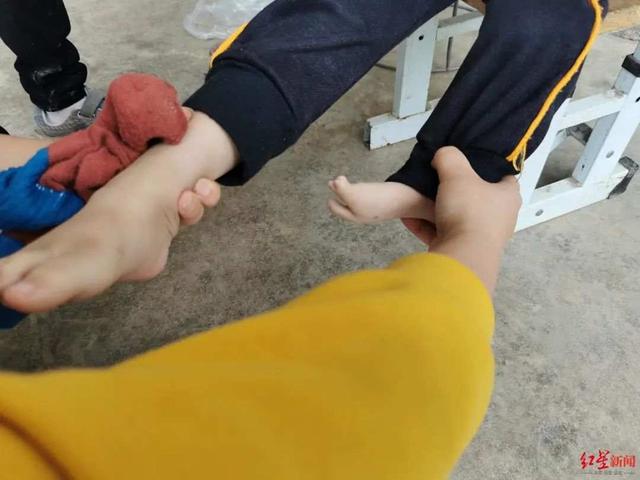 产检四维彩超正常，孩子出生却左小腿畸形，医院漏诊赔偿百万