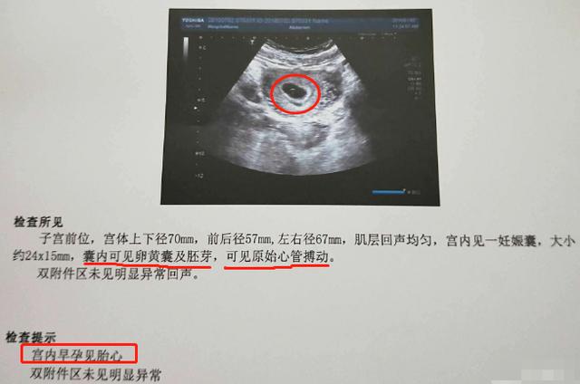 孕早期孕囊图片（孕早期孕囊图片怎么看）
