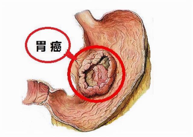 术后对饮食“战战兢兢”，不知道该如何吃？