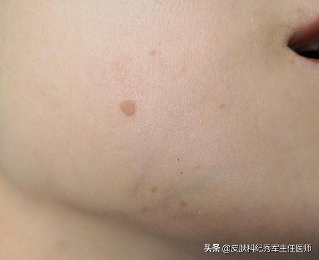 汗管角化症与老年斑的区别