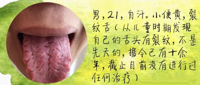 舌头有裂纹是怎么回事（常见的裂纹舌辩证）