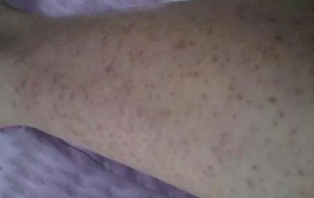 皮肤鸡皮明显