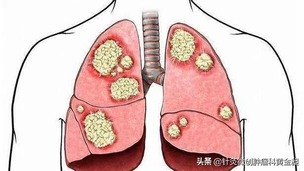 肺癌治疗，要从这五点入手