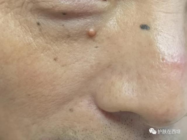 阴囊皮肤汗腺腺瘤图片