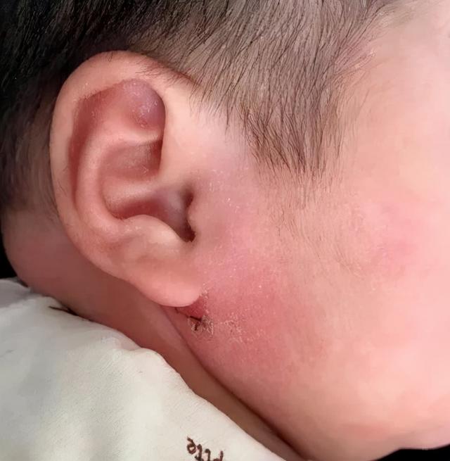 婴儿湿疹与保湿