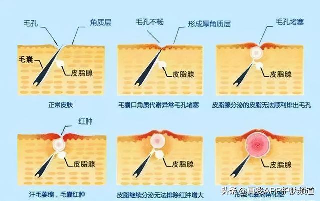 角化过度和角化不良