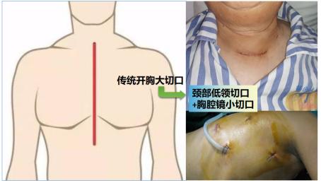 75歲老太太胸悶氣短以為是冠心病，結果卻是甲狀腺腫惹的禍