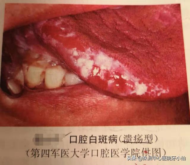 口腔颊白色角化吃什么