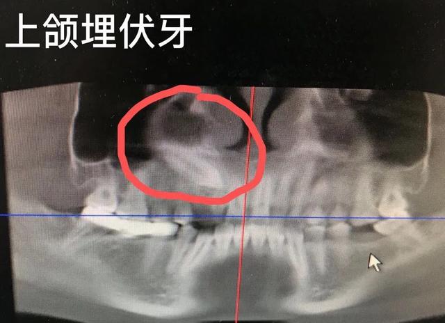 「备孕期」牙病患者需要注意这些