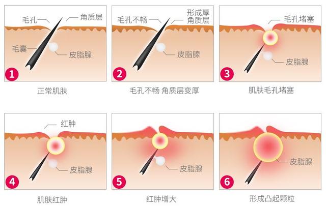 怎么在家去鸡皮疙瘩