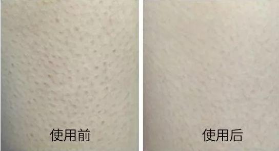 怎么在家去鸡皮疙瘩