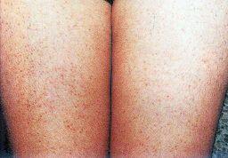 醋加甘油治疗鸡皮肤有副作用吗