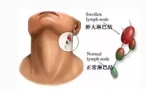非角化性鳞癌鼻咽