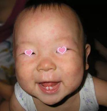 5岁儿童身上大片鸡皮疙瘩