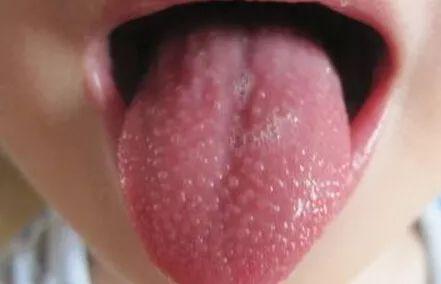 风团鸡皮疙瘩