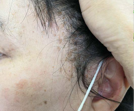 皮肤指异性角化