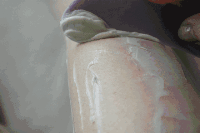 毛囊炎毛周角化知乎