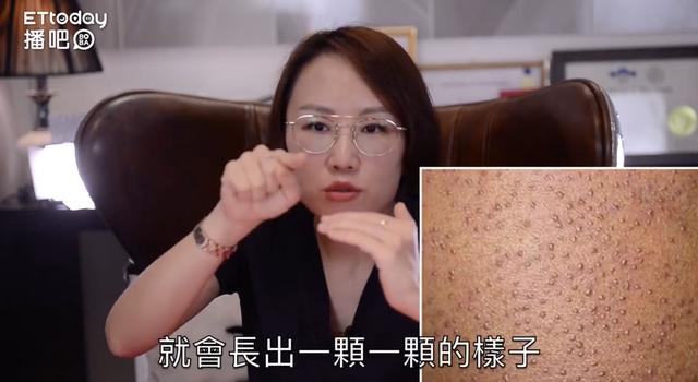 毛周角化症可以用激光根除吗