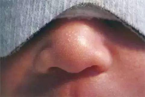 小孩脸部毛周角化图片