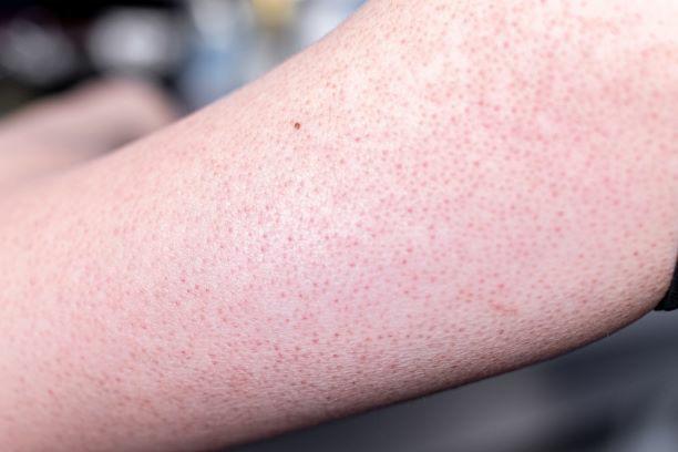 天津河西毛周角化医院