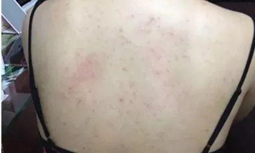 鸡皮疙瘩抓破后红肿