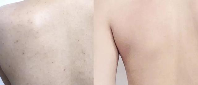 鸡皮疙瘩抓破后红肿