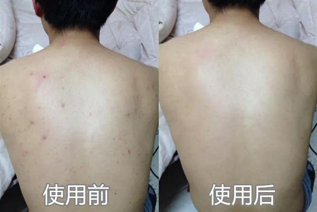 鸡皮疙瘩抓破后红肿