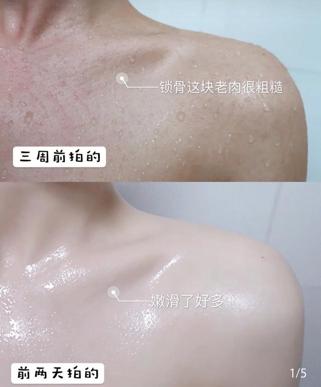鸡皮疙瘩抓破后红肿