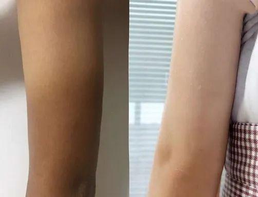 鸡皮疙瘩抓破后红肿