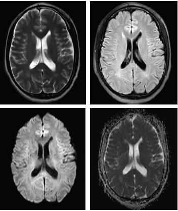 抗病毒治療10天后複查頭mri如下:男,30歲,突發眩暈伴視物重影1天,約20