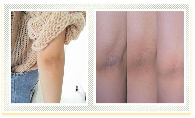 维a酸加入身体乳