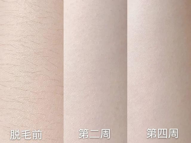 激光脱毛后涂了身体乳