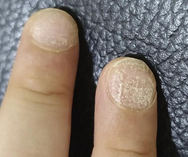 糙甲症|不是粗糙甲都是甲癣