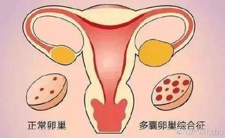 女性最常见的内分泌疾病：多囊卵巢综合征