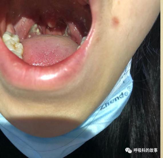 扁桃体肿大表面化脓一定是扁桃体炎吗