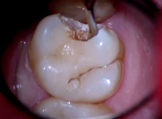 补一次牙,少则几百多则上万,自己疼得受罪,补过的牙也没原来的好使.