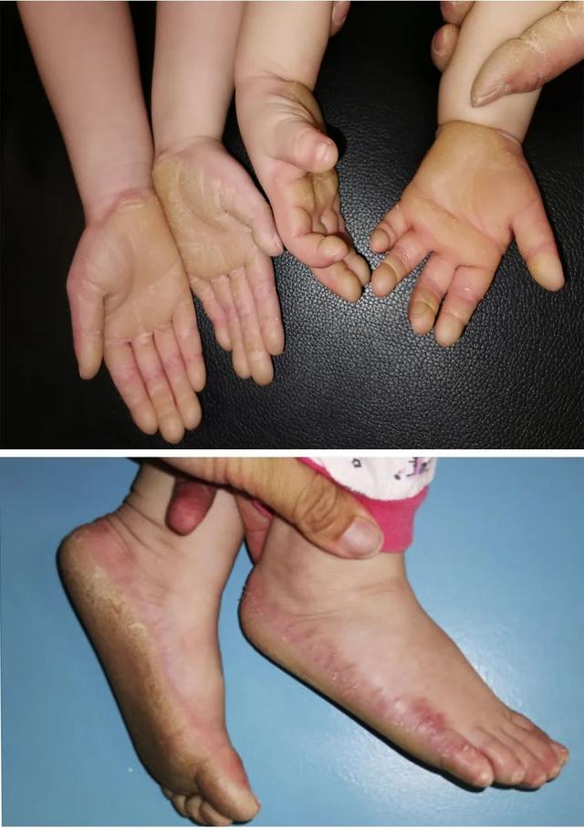 掌趾角化症怎么确诊