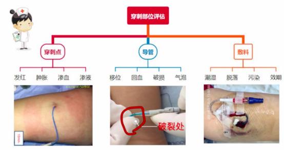 PICC置管你必須知道的那些事兒