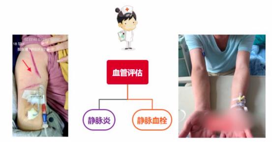 PICC置管你必須知道的那些事兒