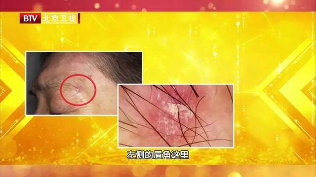 对称红斑角化症为什么发红