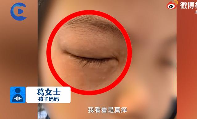浙江小姑娘一做数学就眼睛过敏，眼睛肿到睁不开！妈妈：其他作业没事