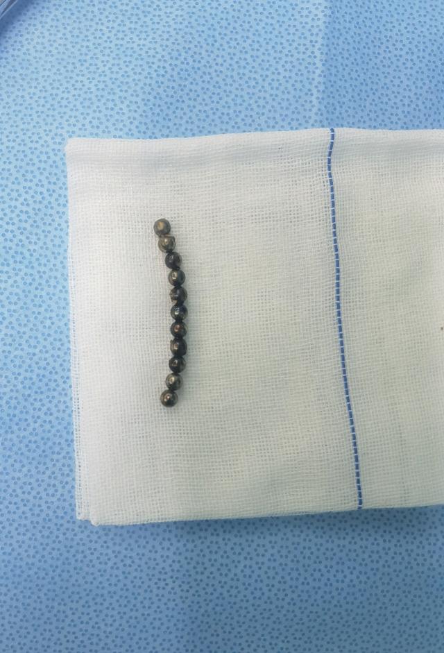 别给孩子玩磁力珠！3岁男童误吞11颗磁力珠 致4处肠穿孔