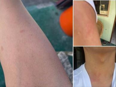 过敏扩散鸡皮肤