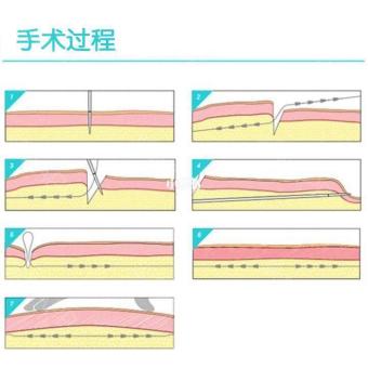 脸部松弛下垂怎么办