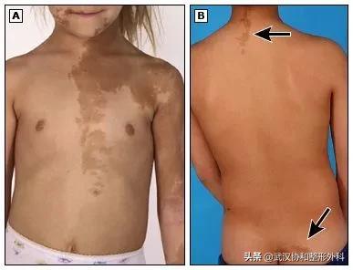 是“疾”不是“记”！警惕宝宝身上的“咖啡牛奶斑”