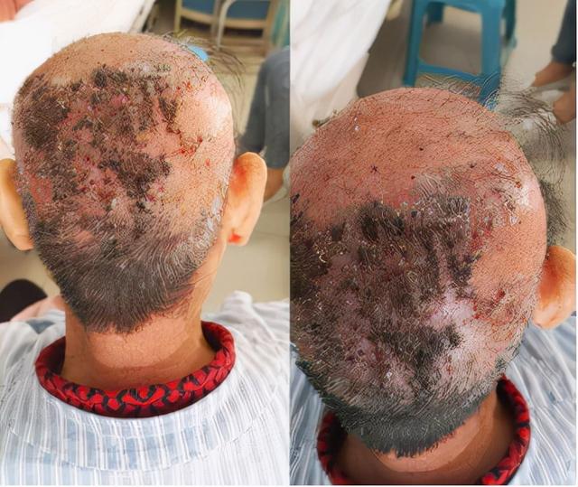 靶向治疗，出现皮疹怎么办？中医辛凉透疹，清热解毒，止痒祛皮疹