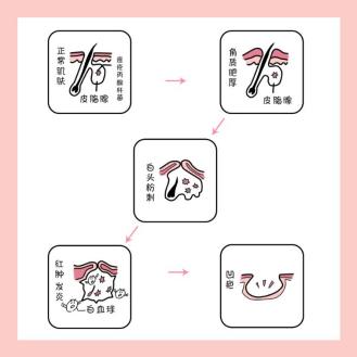 男生适合用的去角质产品？