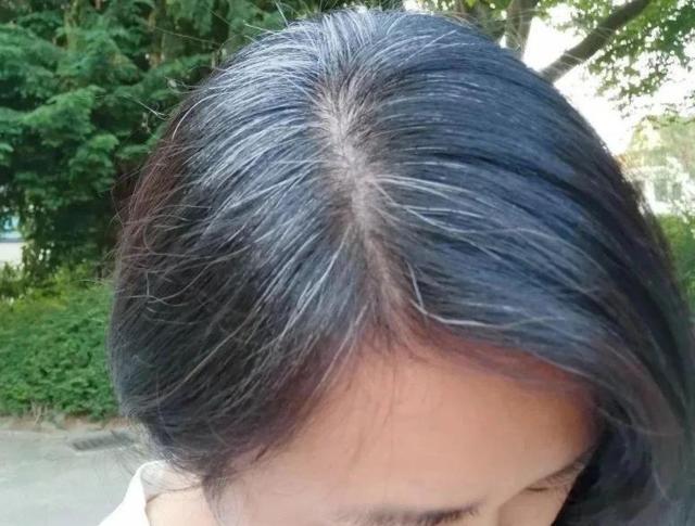 女子白头发日渐增多，别总觉得老了，或是缺了这3大营养素