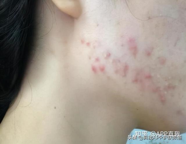 毛周角化涂玻尿酸