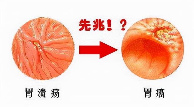 胃溃疡导致的后果有多严重？可致癌？这些饮食千万要注意了